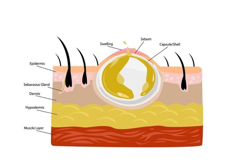 Abscess
