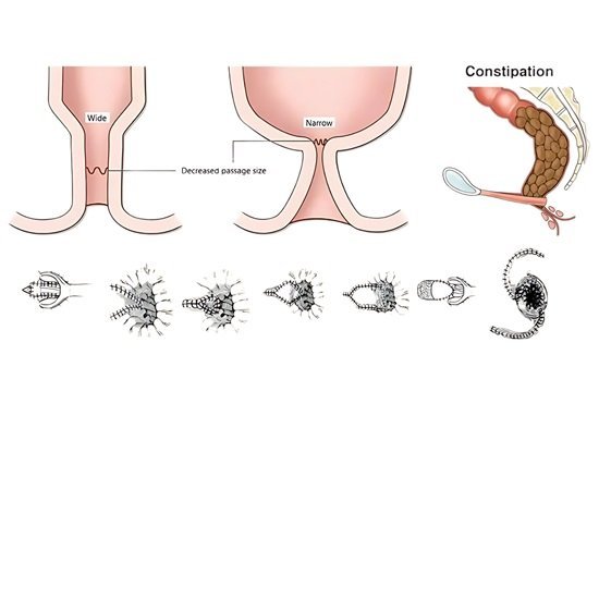 Anoplasty Surgery