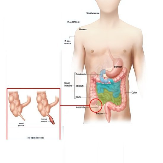 Appendix in Children