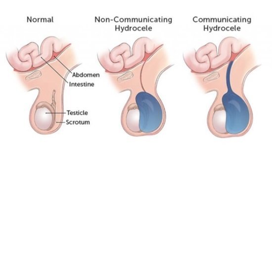 Hydrocele in Children