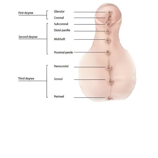Hypospadias in Boys: A Parent's Guide to Treatment