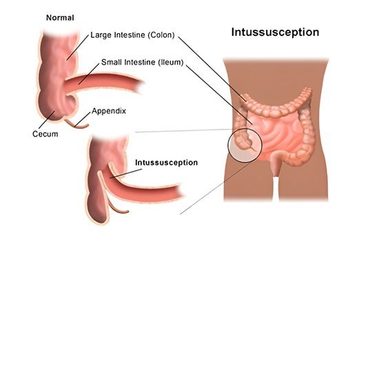 Intussusception