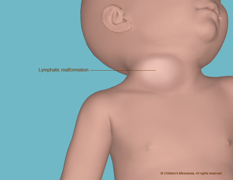 Lymphangioma Surgery