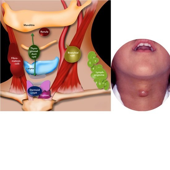 Neck Cyst