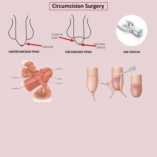 Preputioplasty (Alternative to Circumcision)