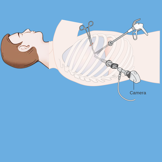 Thoracoscopy in Children